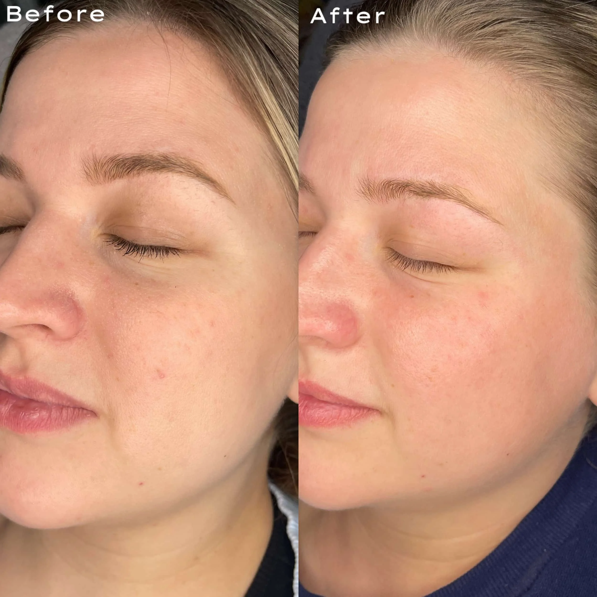 Side-by-side comparison of a woman's face, showing her with closed eyes in a 'before' and 'after' skincare treatment, highlighting improved skin texture and clarity.