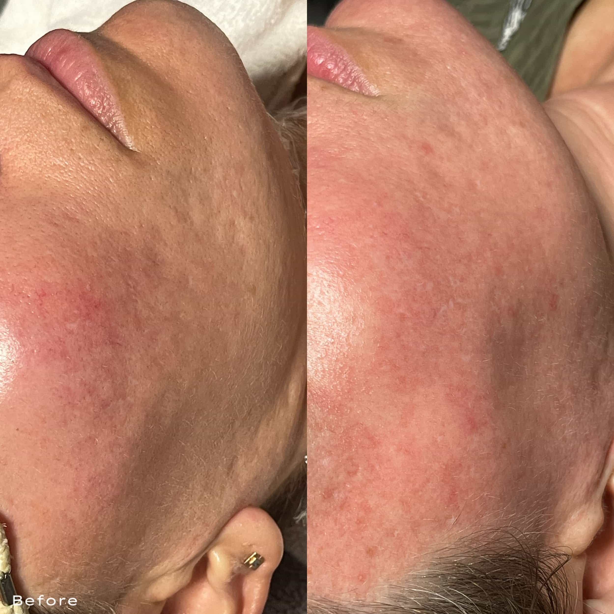 Close-up of a person's cheek before and after skincare treatment, showing improved skin texture and reduced redness.