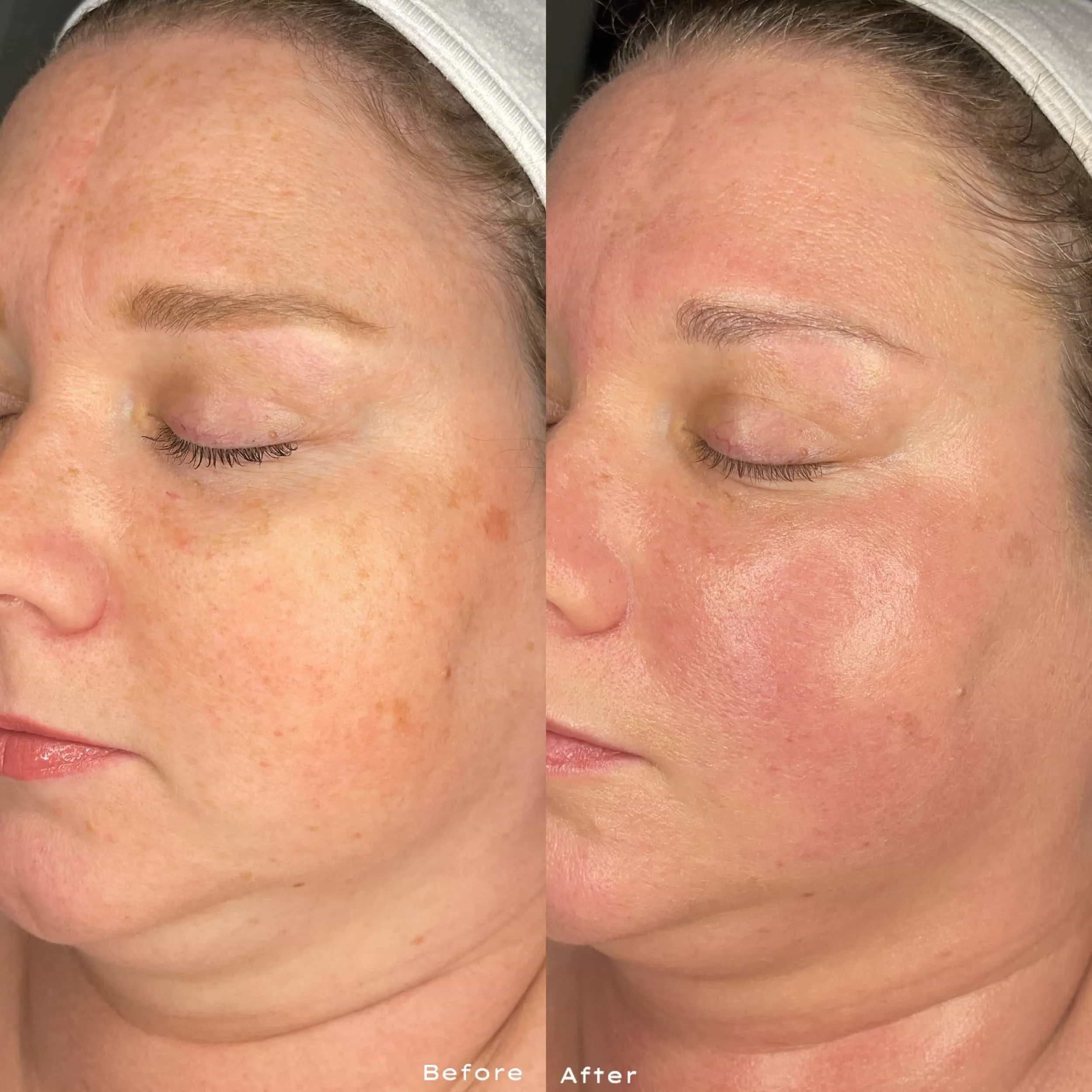 Side-by-side comparison of a woman's face showing before and after skincare treatment; before image shows hyperpigmentation and uneven skin tone, after image shows clearer, more even skin with reduced discoloration.