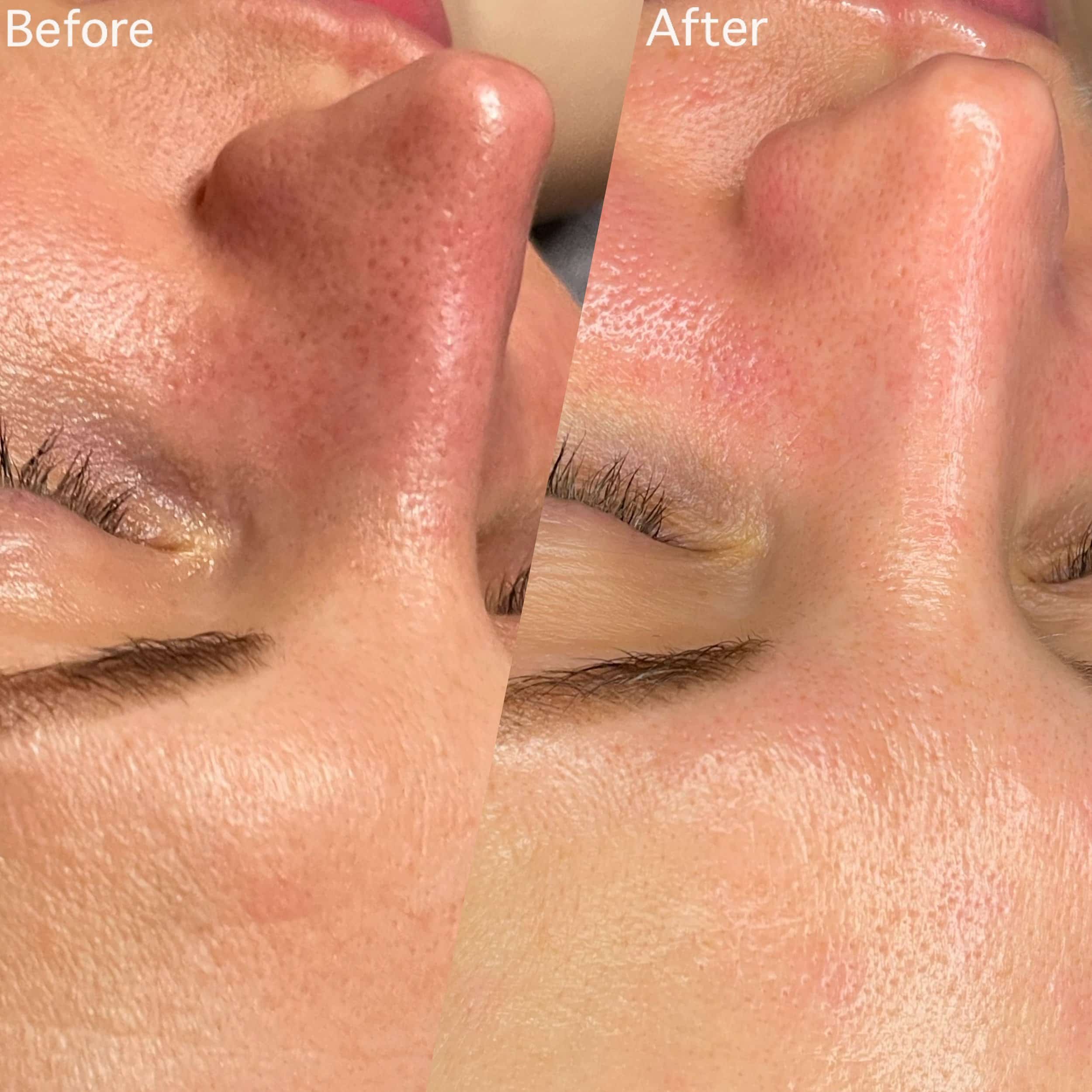 Close-up of a person's nose and cheek showing before and after skin treatment, with visible reduction in pore size and improved skin texture.