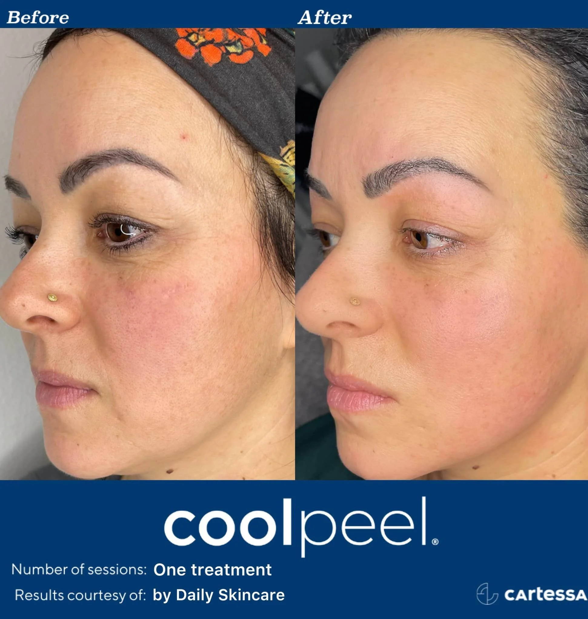 Side-by-side comparison of a woman's face before and after one Cool Peel treatment showing clearer skin with reduced redness and blemishes.