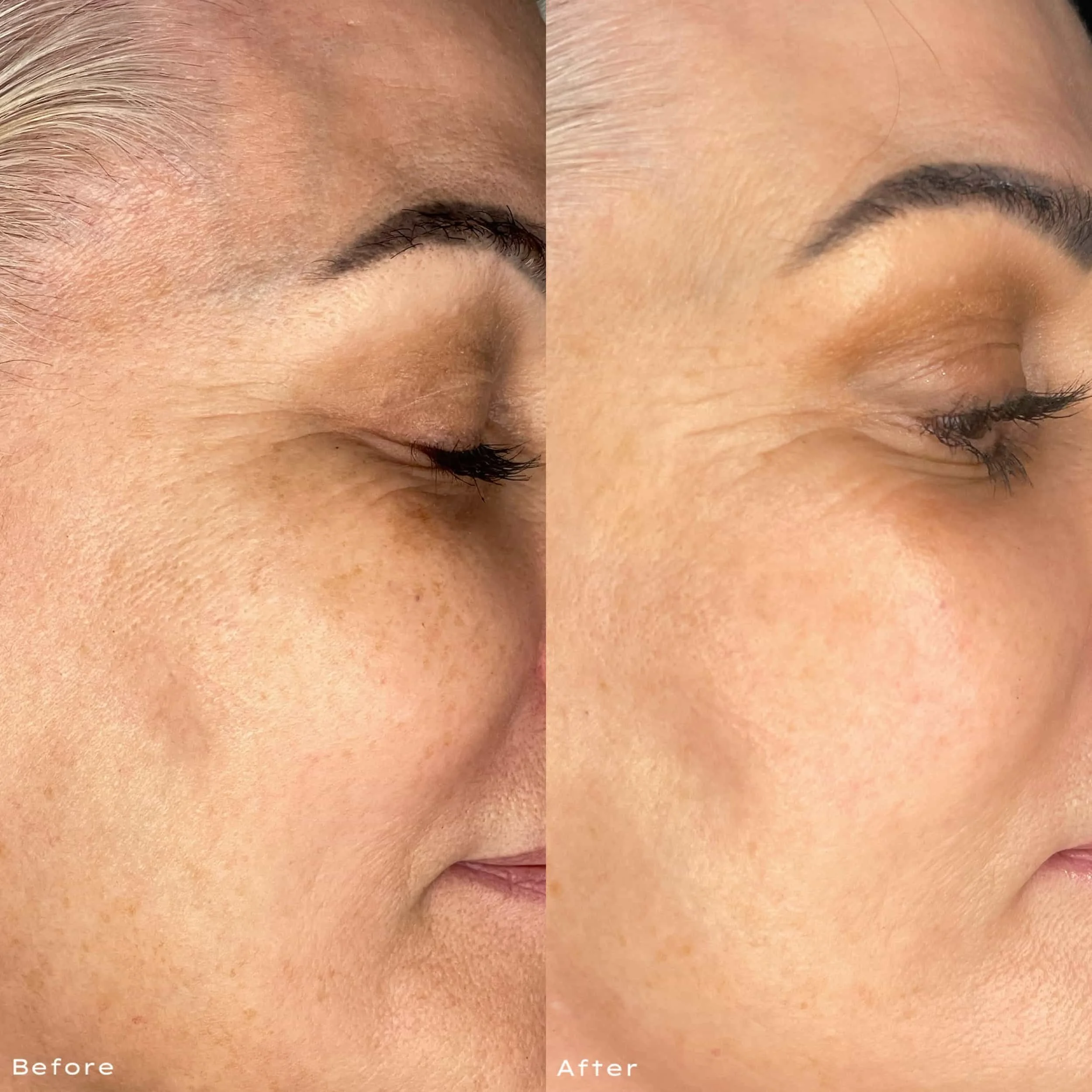 Side-by-side comparison of a person's face showing skin before and after a skincare treatment, with smoother and clearer skin in the after image.