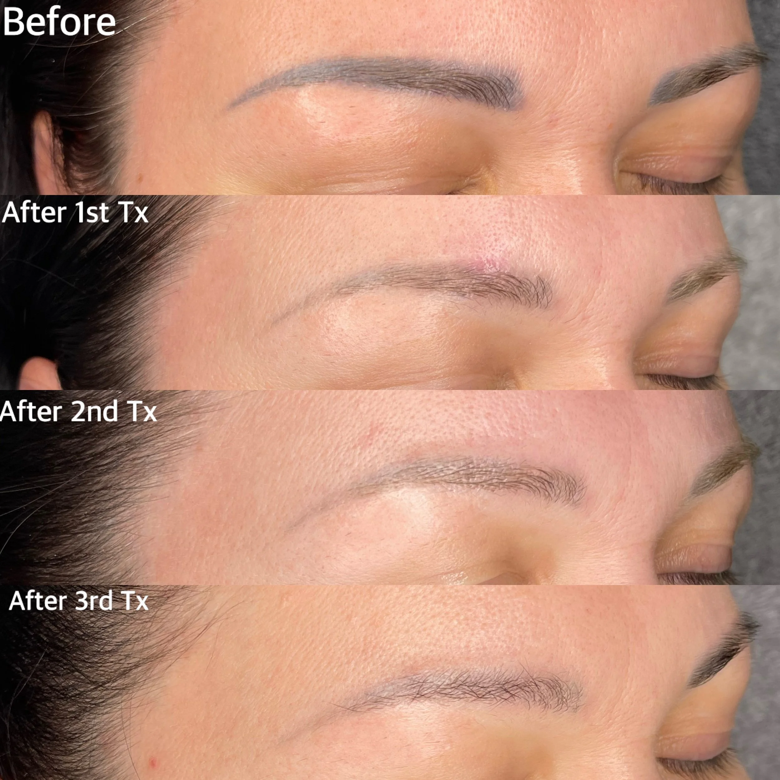 Progression of eyebrow enhancement treatment showing four stages: before treatment, after first treatment, after second treatment, and after third treatment, tattoo removal eyebrows