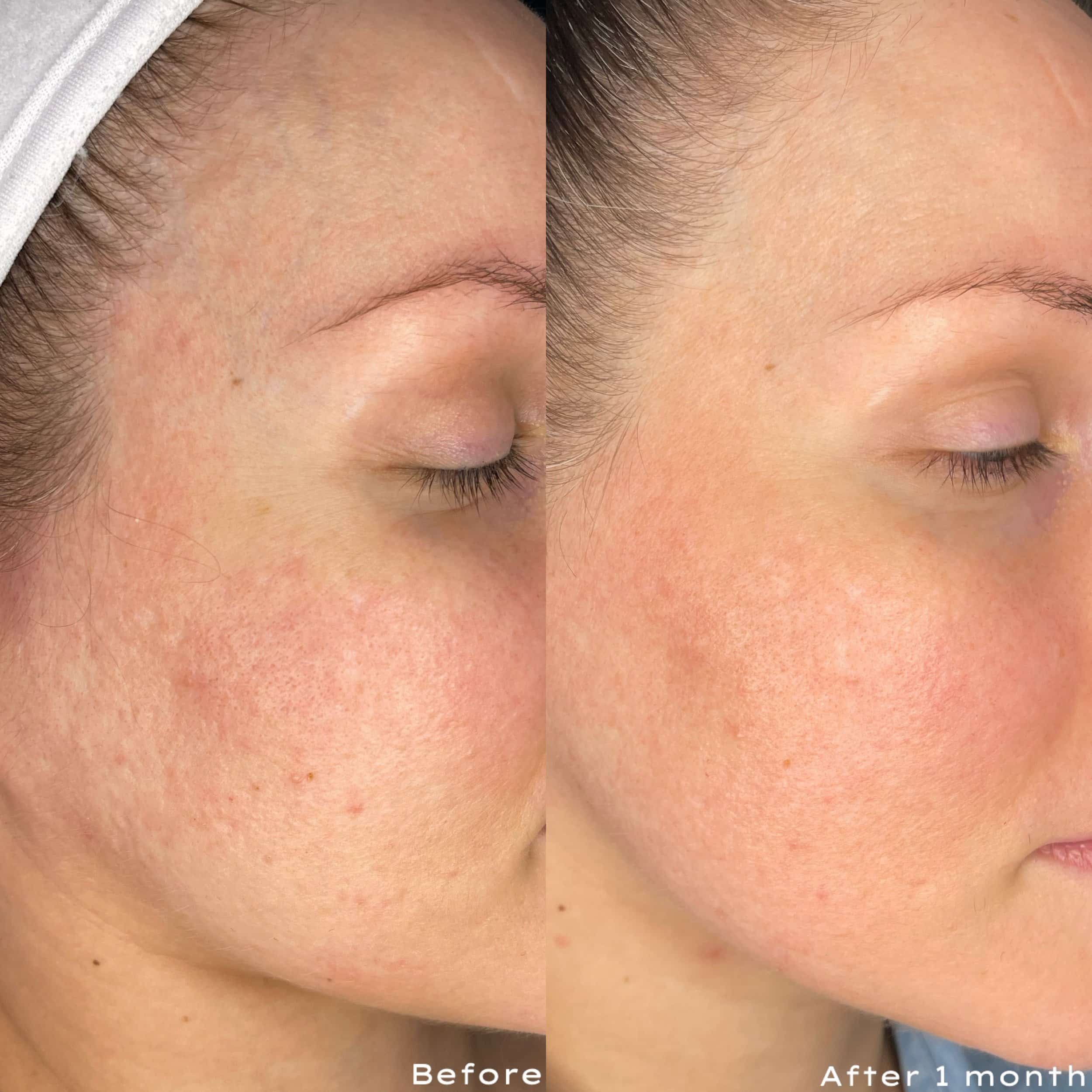 Close-up of a woman's face showing a before and after comparison of skin improvement; the before side shows redness and uneven skin tone, while the after side shows clearer, more even-toned skin.