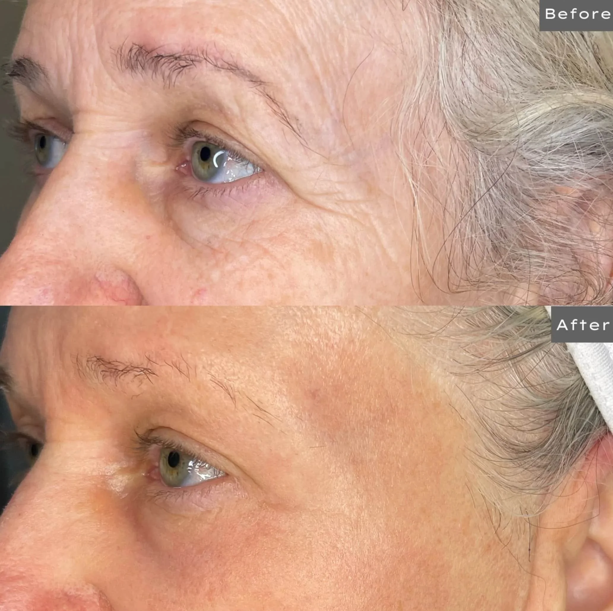 Close-up comparison of a woman's eye area showing skin improvement after a treatment, with the 'before' image displaying wrinkles and fine lines, and the 'after' image showing smoother skin with fewer wrinkles.