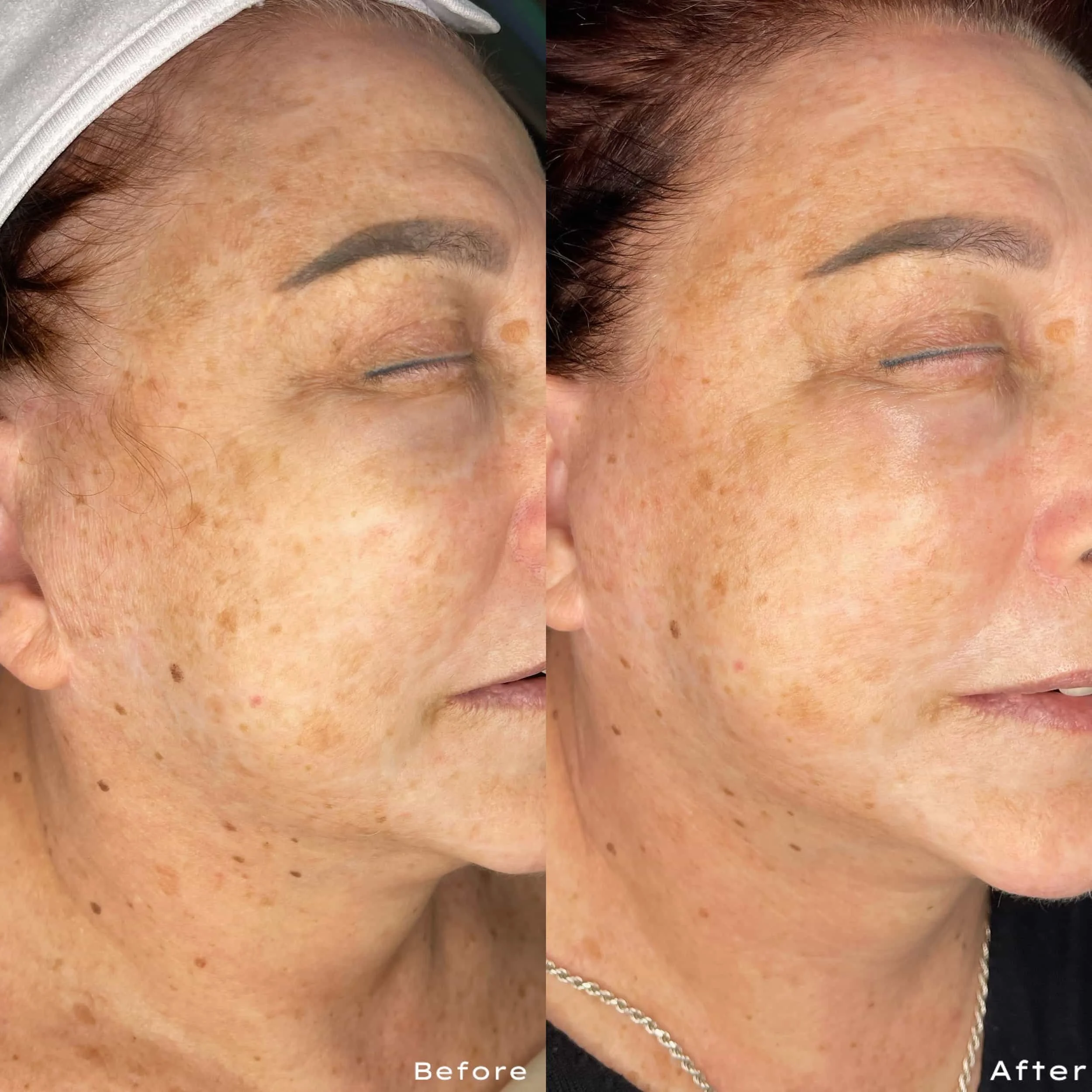Side-by-side comparison of a woman's face showing skin improvements. The left side labeled 'Before' and the right side labeled 'After'.