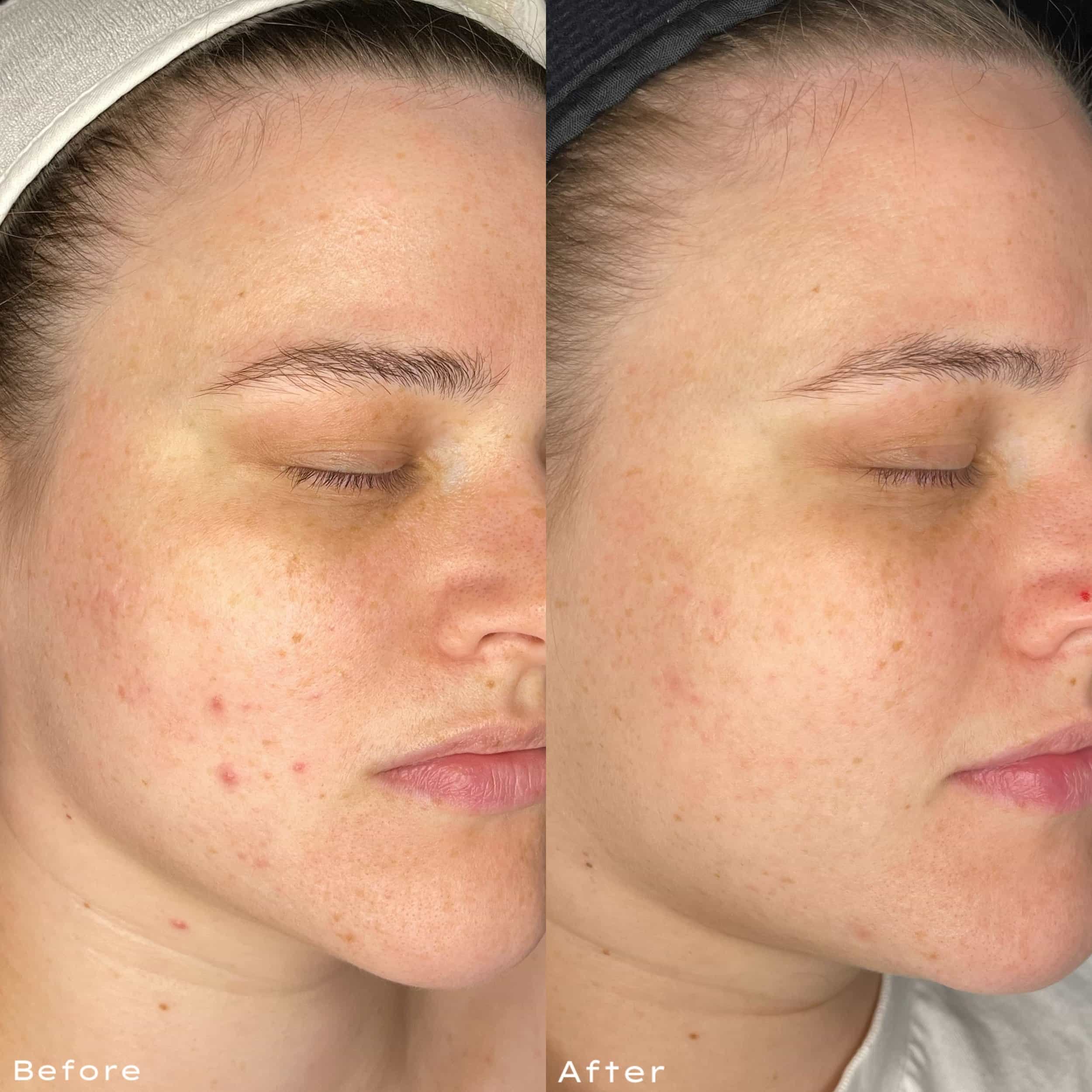 Comparison of a woman's face before and after skincare treatment, showing reduced redness and acne.