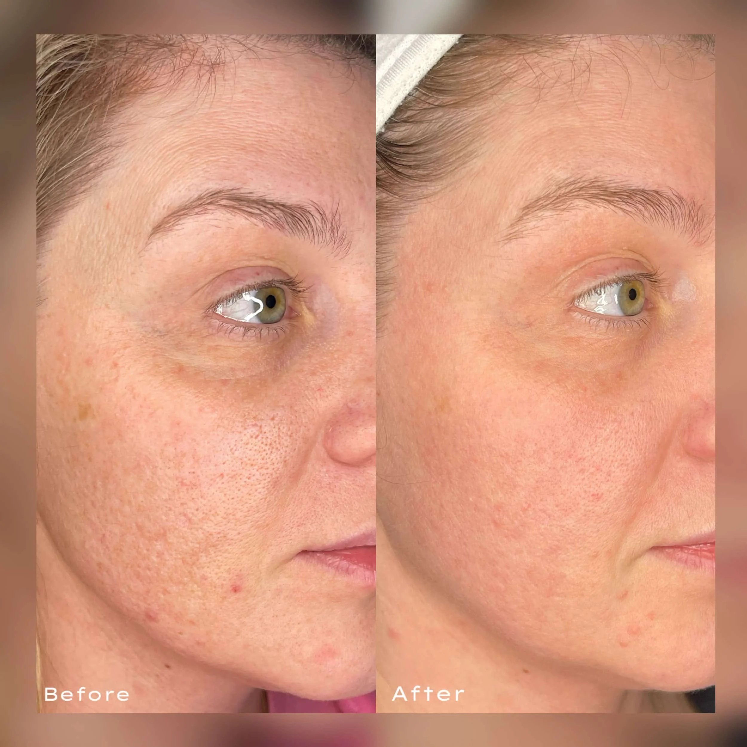 Side-by-side comparison of a woman's face showing skin improvement; left side labeled 'Before' with acne scars and uneven skin tone, right side labeled 'After' with smoother, clearer skin.