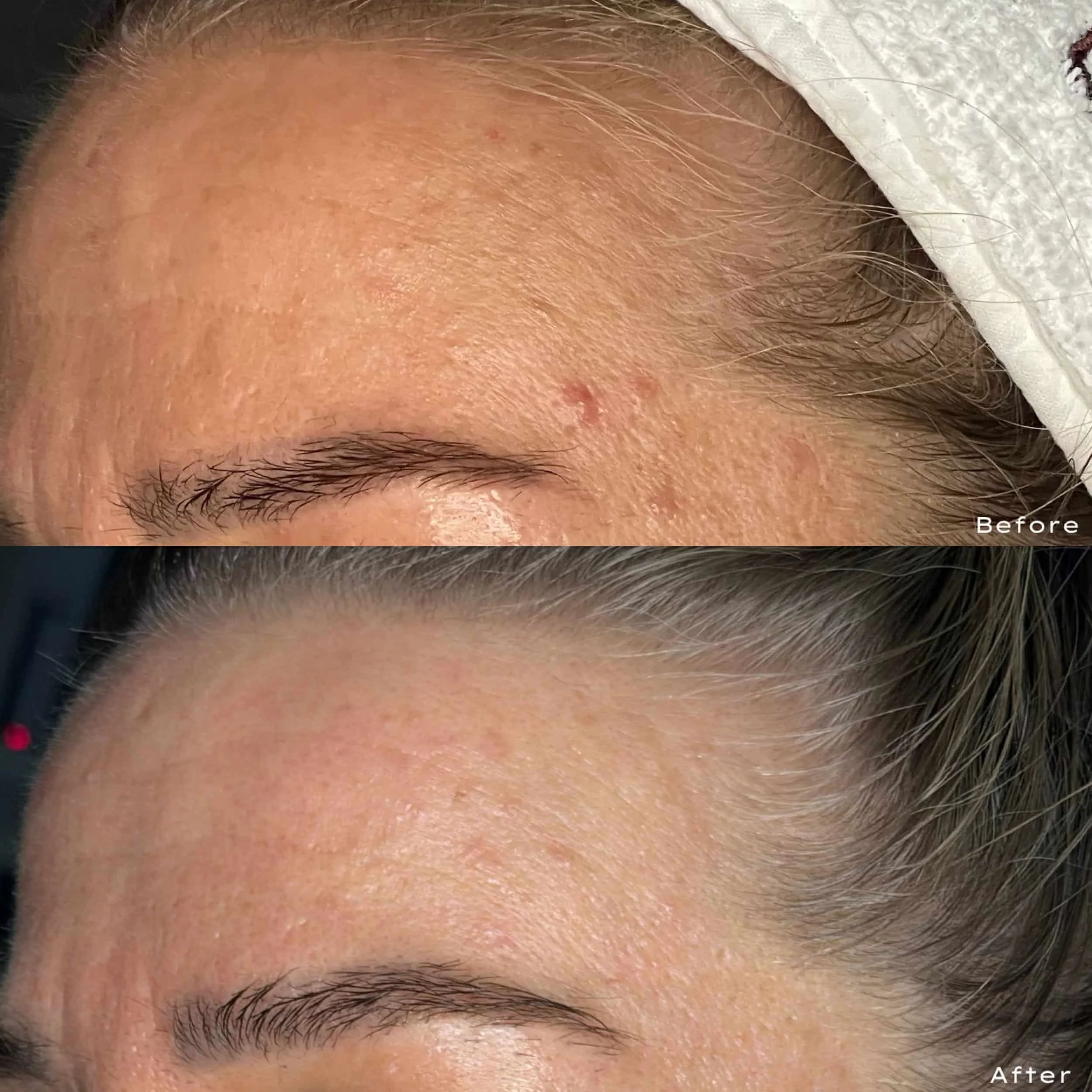 Close-up of a woman's forehead showing before and after skin treatment. The 'before' image displays blemishes and uneven skin texture, while the 'after' image shows clearer, smoother skin with reduced imperfections.