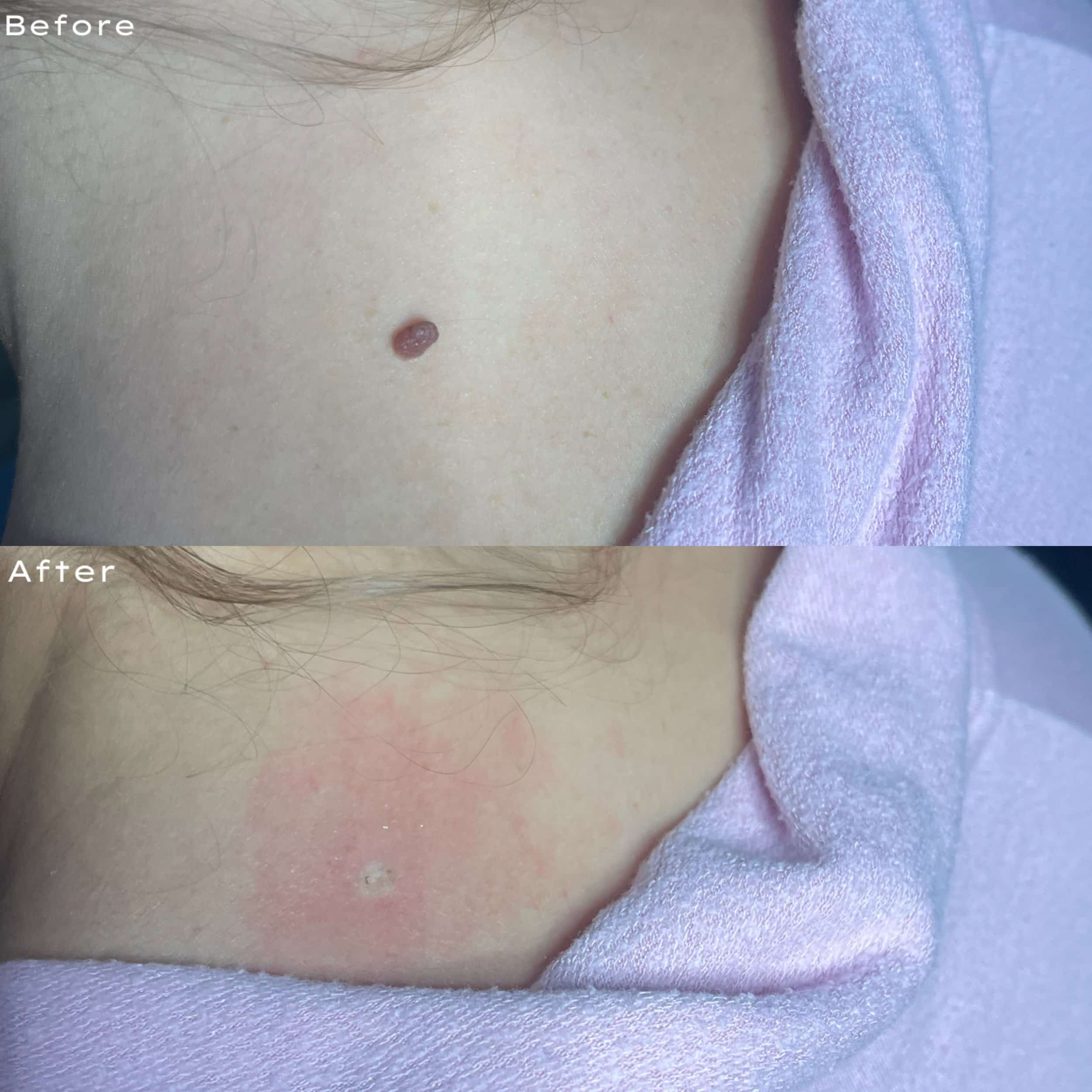Comparison of skin before and after a skin treatment, showing reduction in redness, pimples, and irritation.
