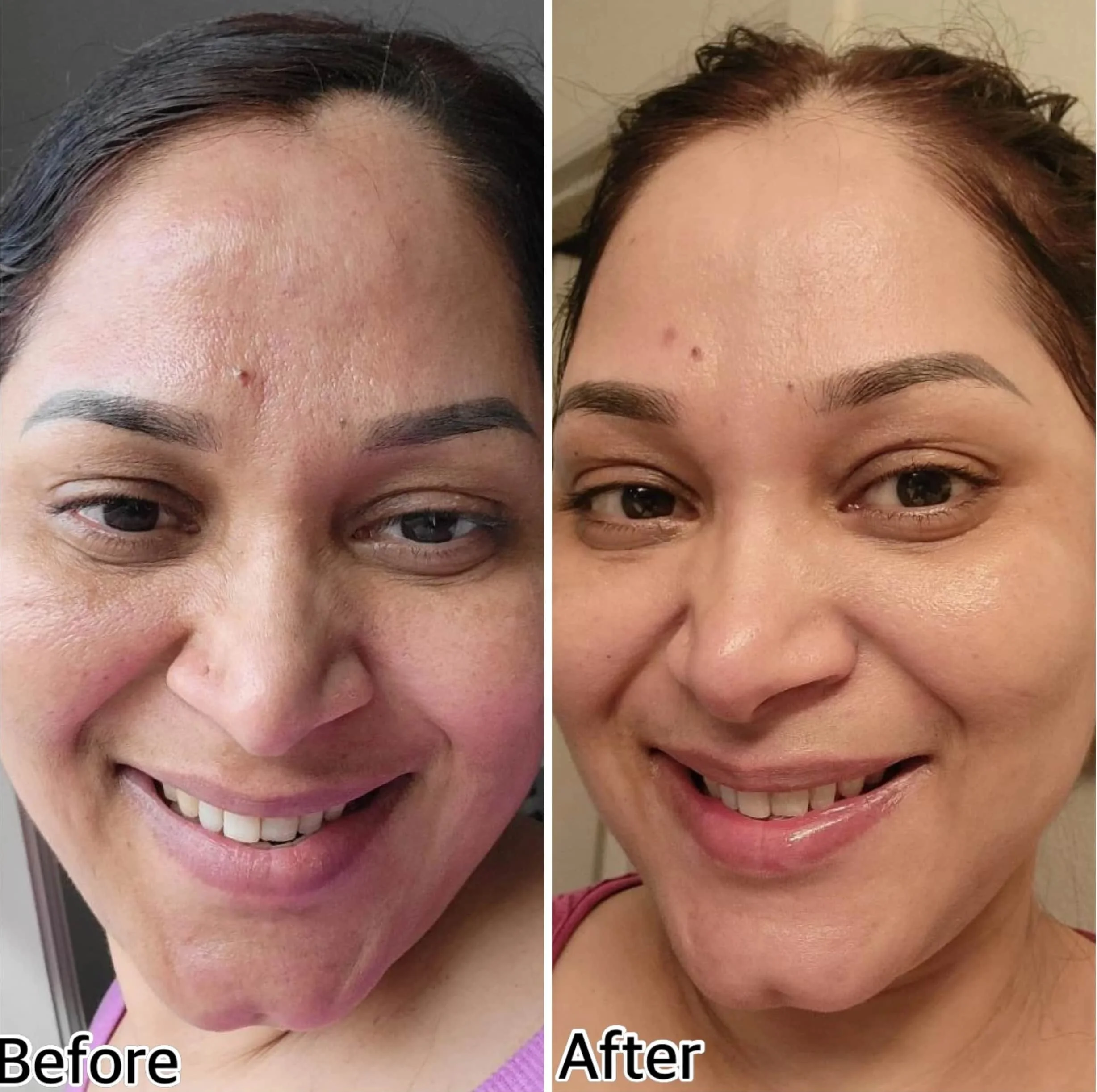 Side-by-side comparison of a woman's face labeled 'Before' and 'After.' The 'Before' side shows acne and uneven skin texture. The 'After' side shows clearer skin with reduced acne and smoother appearance.