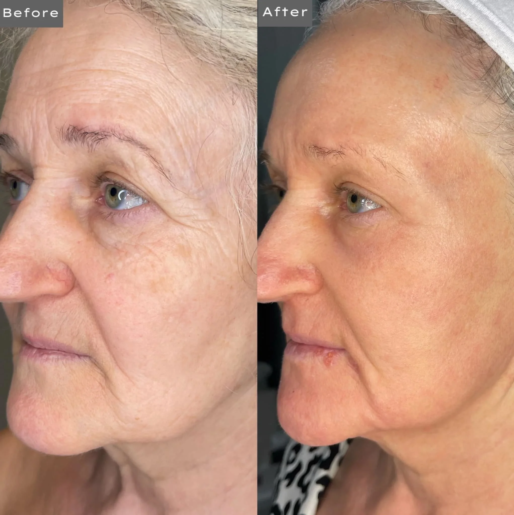 Side-by-side comparison of a woman's face before and after skincare treatment, highlighting reduced wrinkles and improved skin texture.