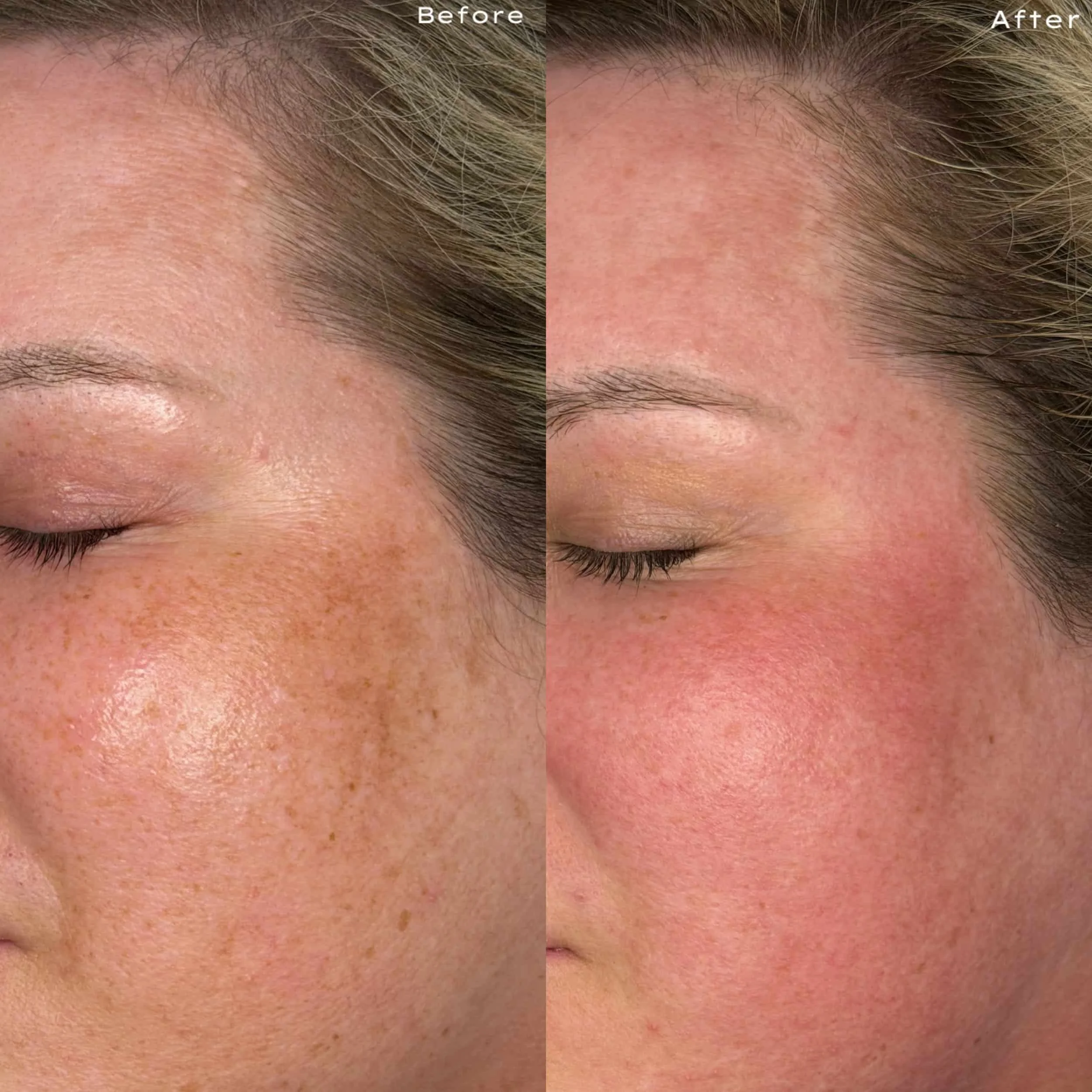 Side-by-side close-up images of a woman's face showing skin improvement. The left image is labeled 'Before,' with visible freckles and uneven skin tone. The right image is labeled 'After,' showing clearer skin with reduced freckles and redness.
