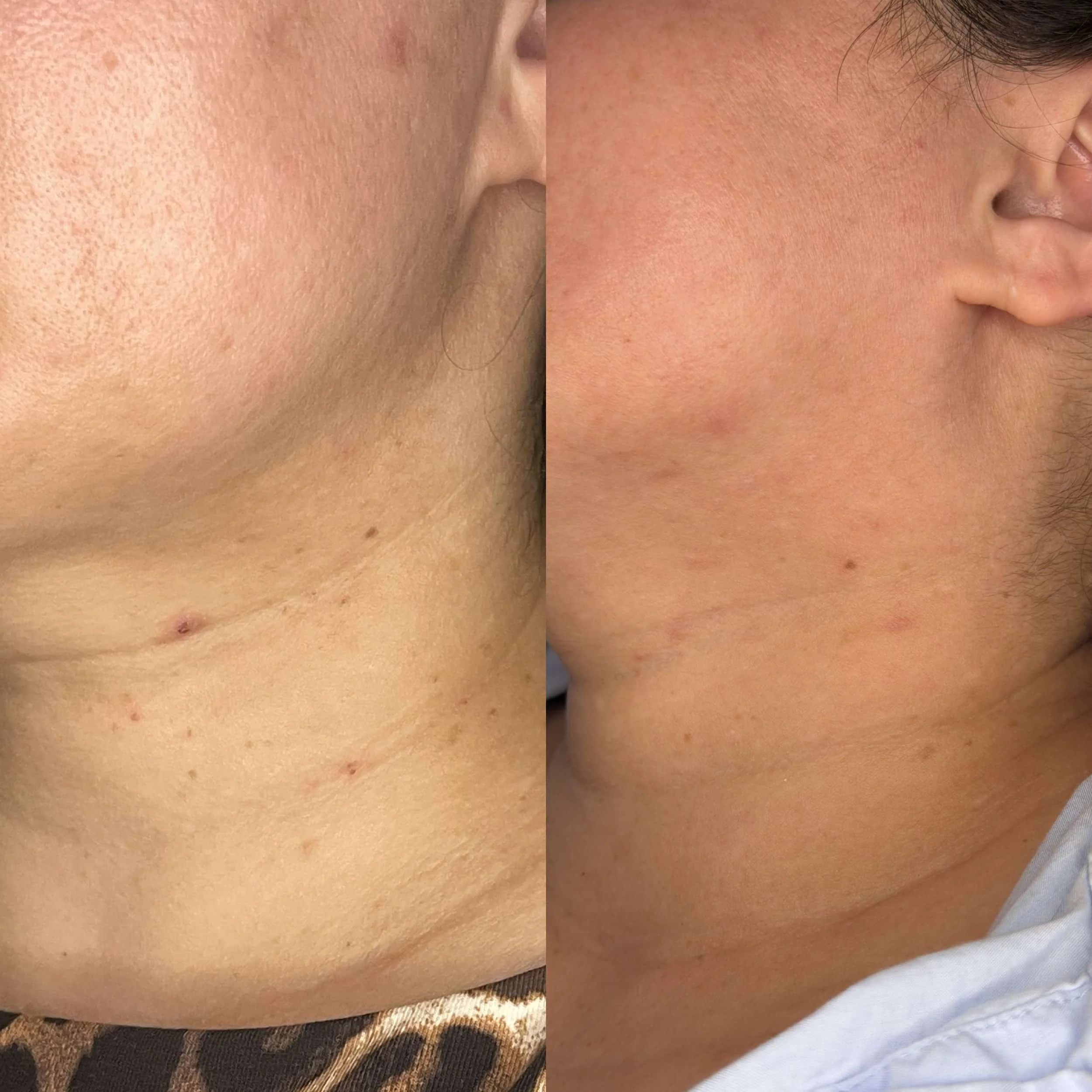 Side-by-side comparison of skin on the neck, showing improvement in skin texture and reduction of blemishes.