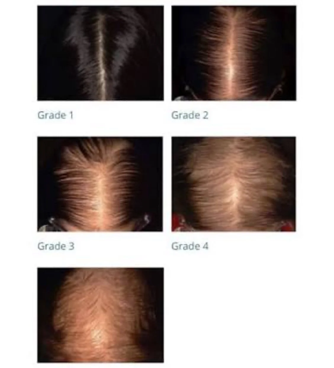 Embracing Confidence: Understanding Alopecia and Finding Your Style Again.      