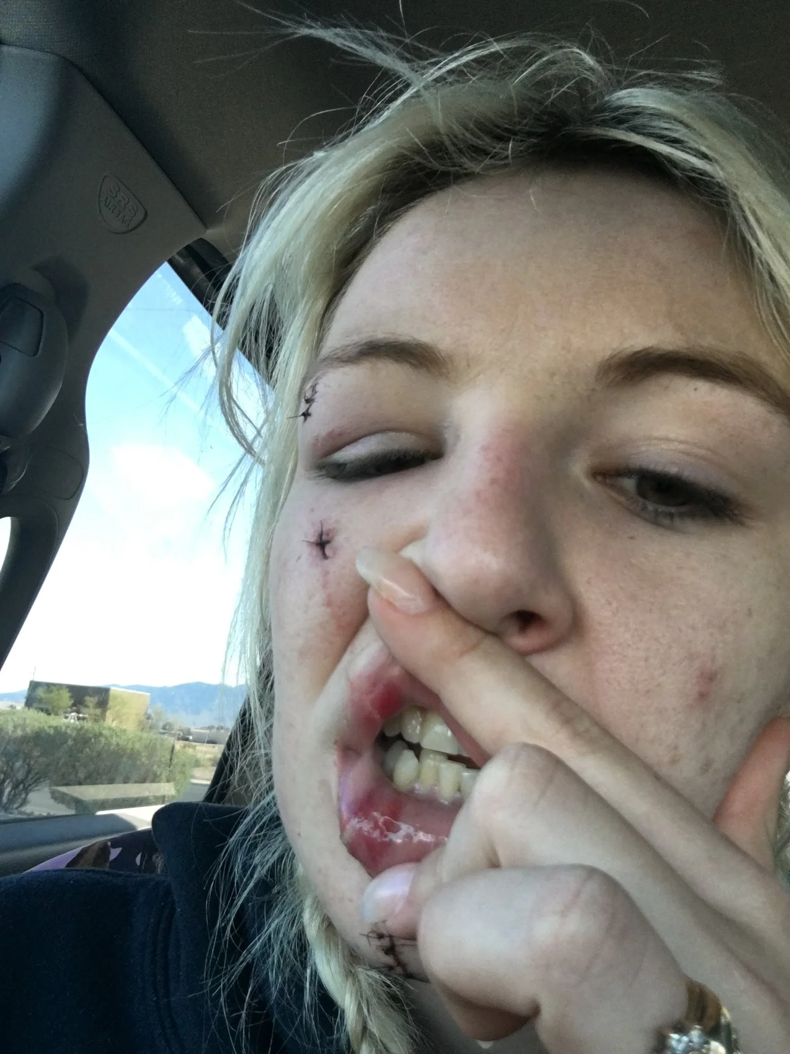 Story time! 

I&rsquo;m asked about my scar a lot on the campaign trail. 

10 years ago I was kicked in the face loading a young horse into a trailer. I went to bump his hip with the door and he fired out with both back feet. Clipping me in the face 