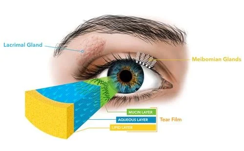 What Is Meibomian Gland Dysfunction (MGD) — and Why It Matters for Eye Comfort