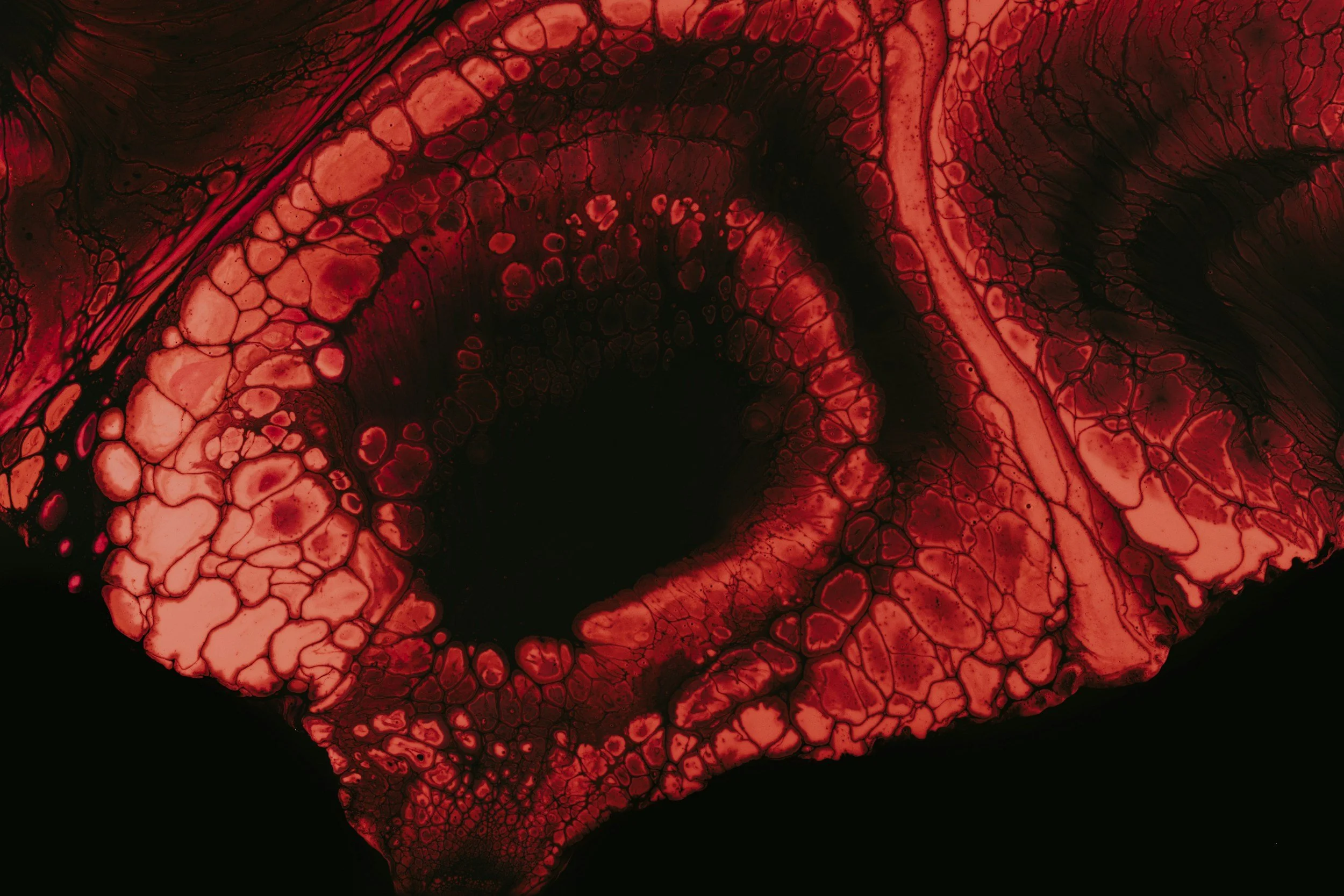 Understanding Pigmentary Dispersion Glaucoma: Causes, Symptoms, and Treatment