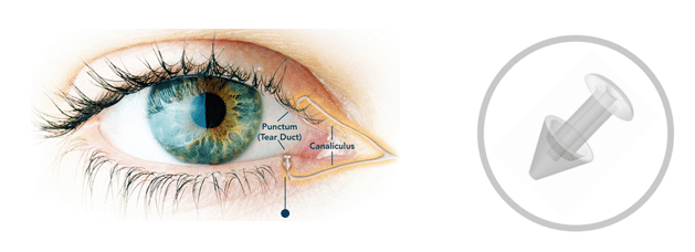 Punctal Occlusion: An Effective Treatment for Dry Eye