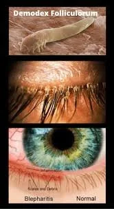 The Link Between Dry Eye Disease and Demodex: Why Treating Both Matters