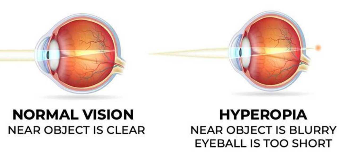 A normal eye vs an eye with hyperopia
