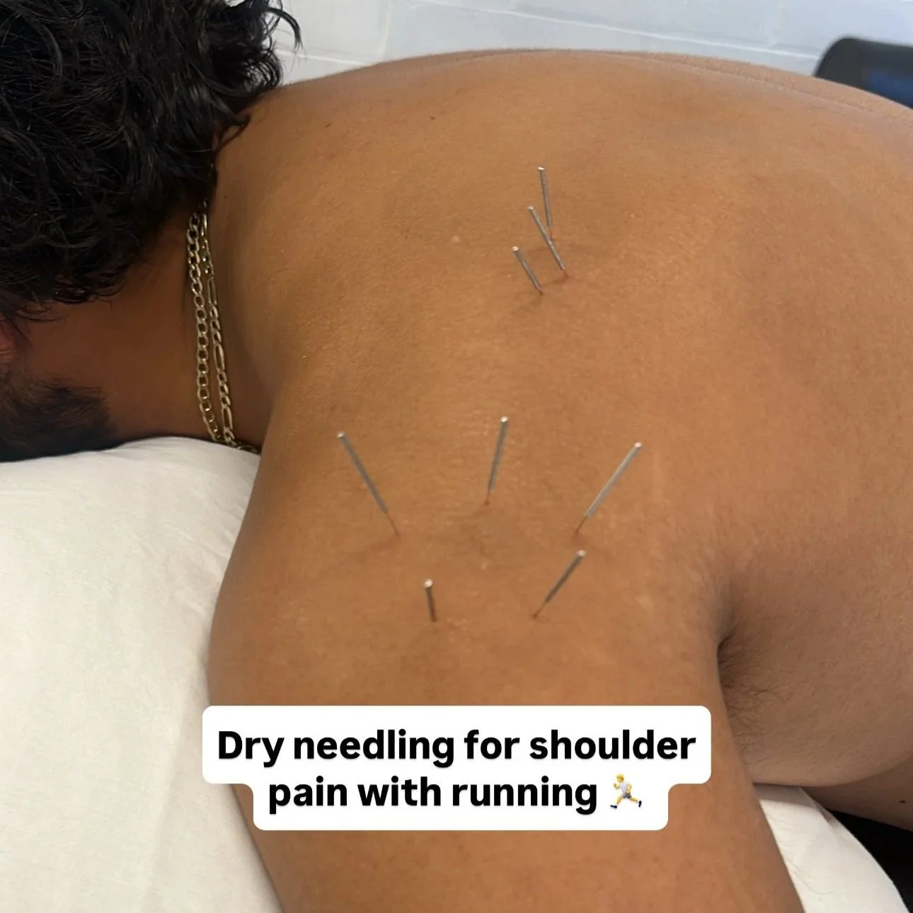 dry needling on shoulder for frozen shoulder in Scottsdale.