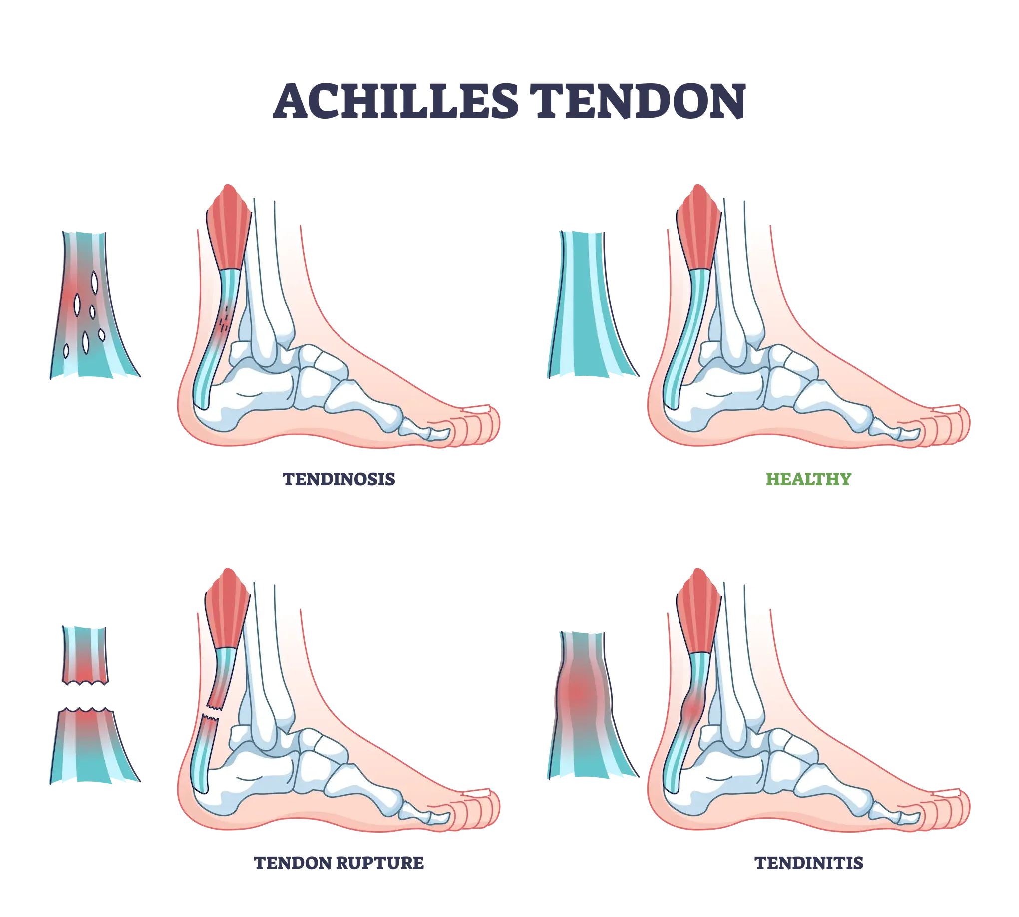 Achilles tenodon showing the difference between an ankle with tendinosis, a health ankle, ruptured tenodon, and tendinitis.