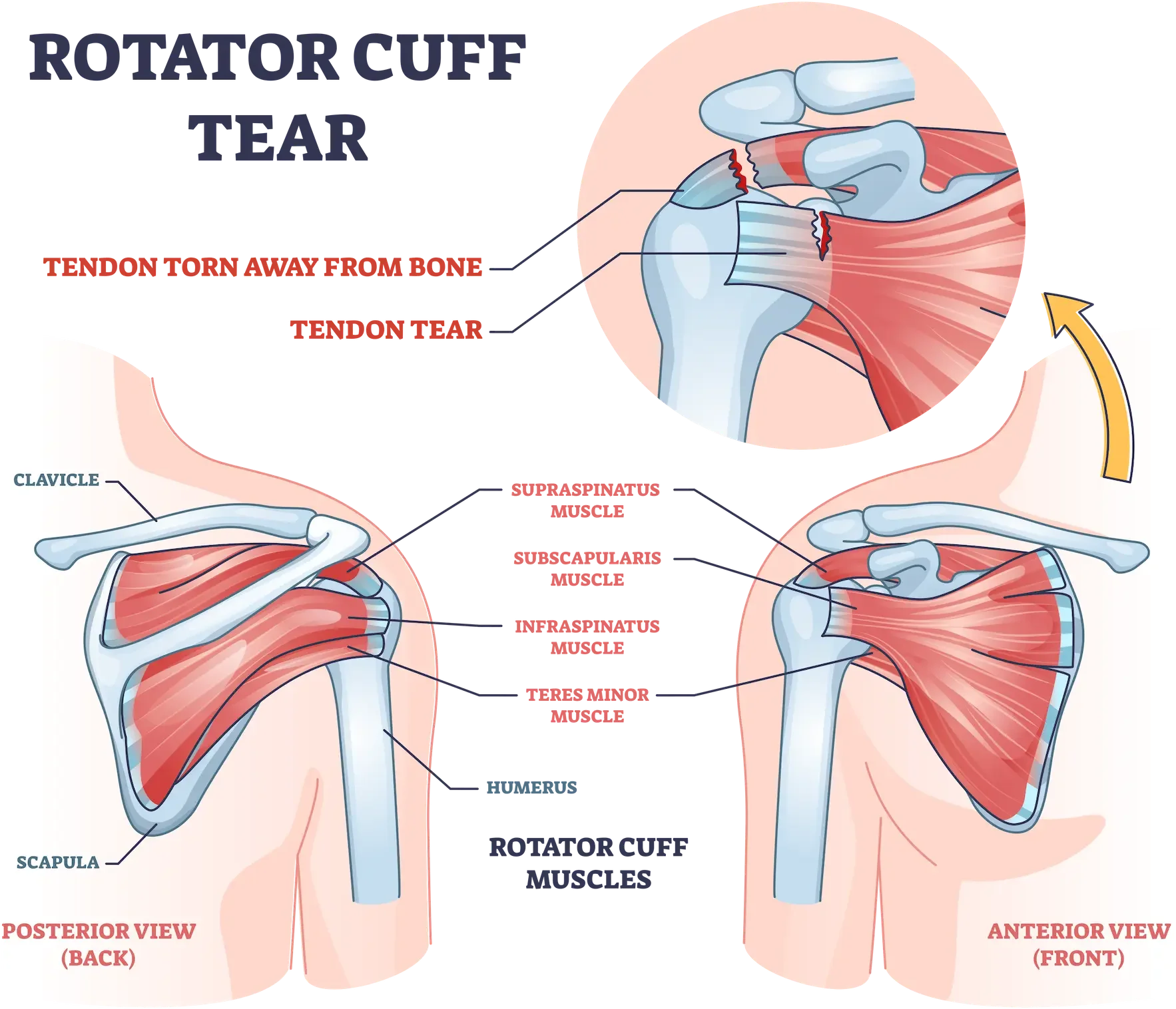 rotator cuff tear physical therapy in Scottsdale and Arcadia.