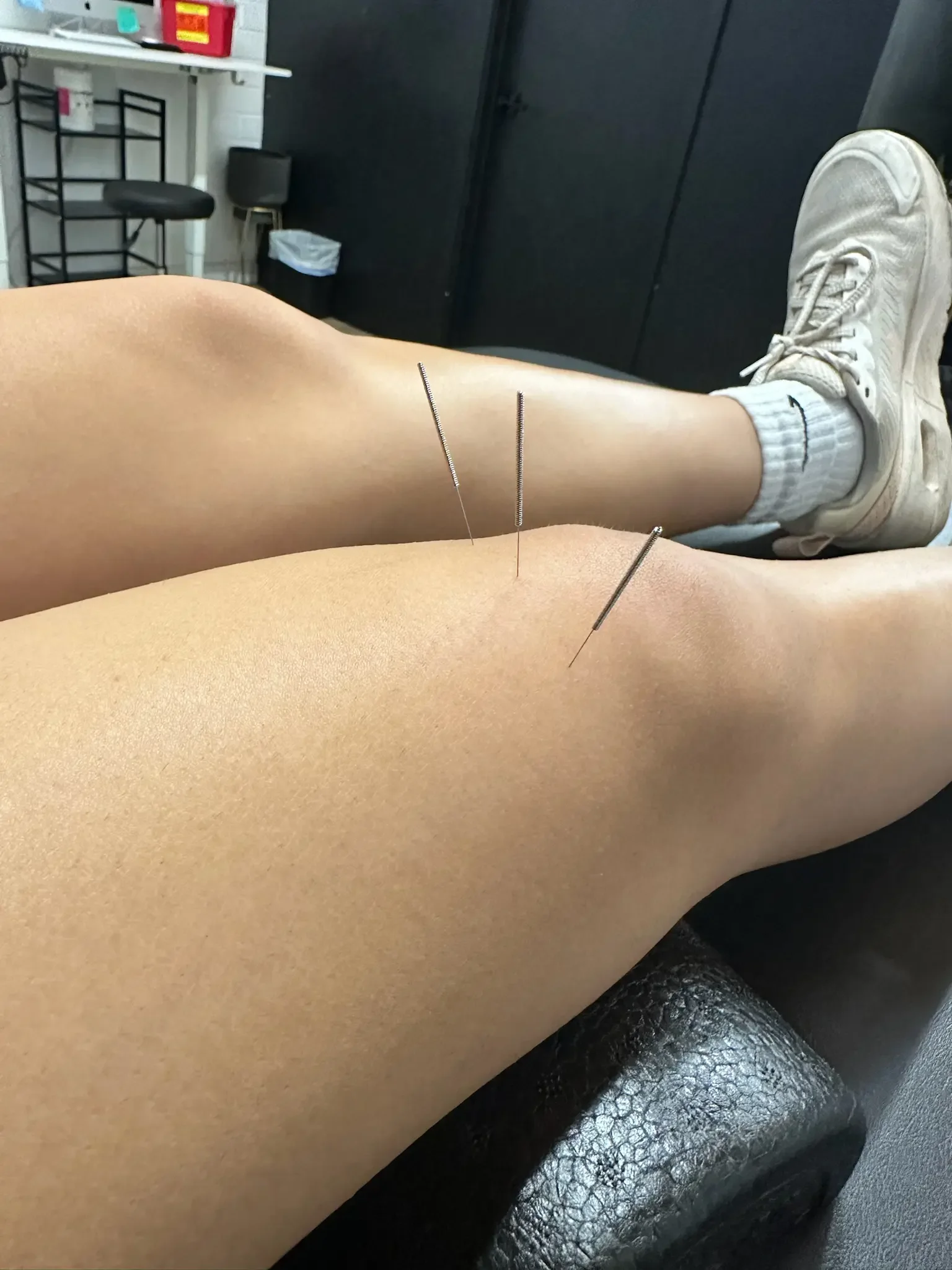 physical therapist who does dry needling in Scottsdale.