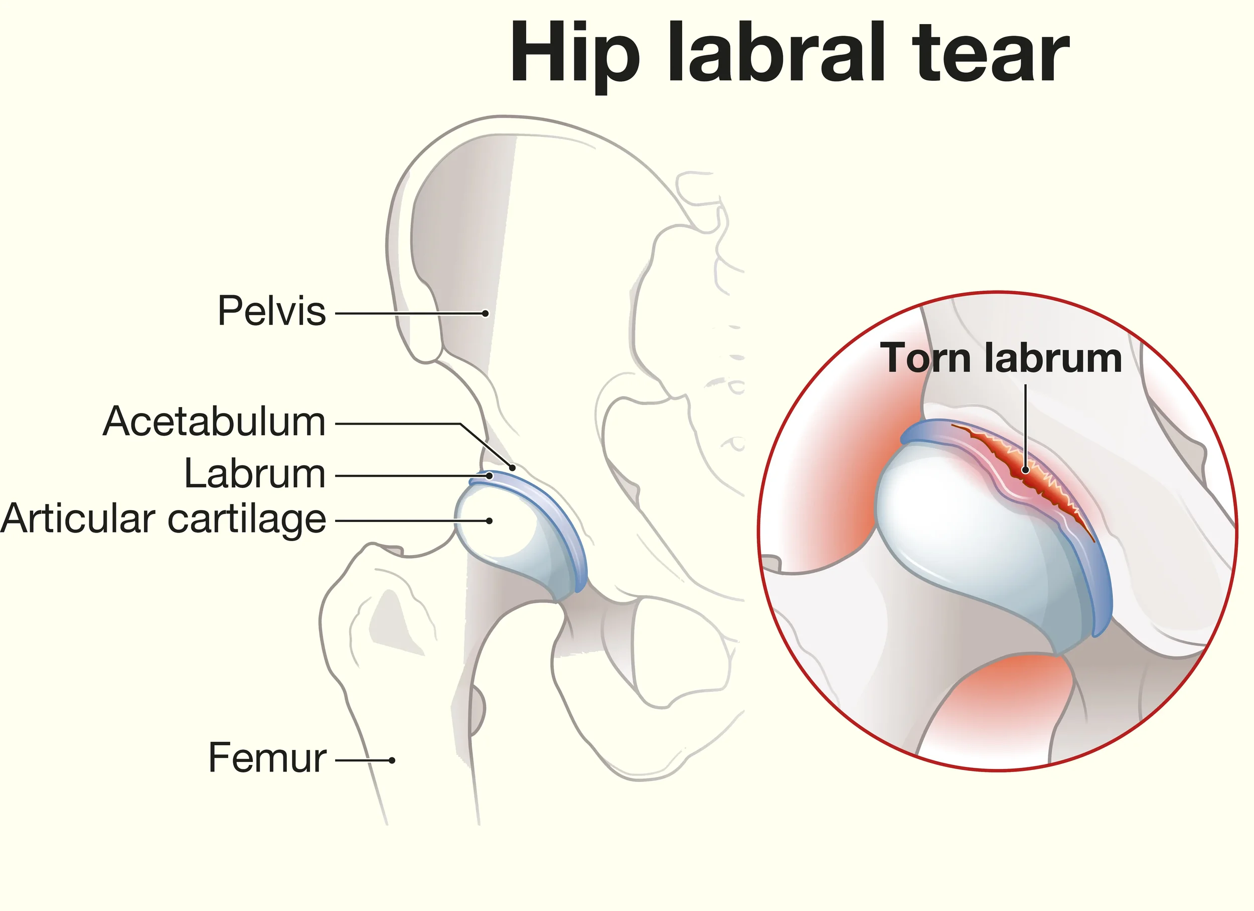 hip labral tear physical therapy in Scottsdale and Arcadia, AZ.