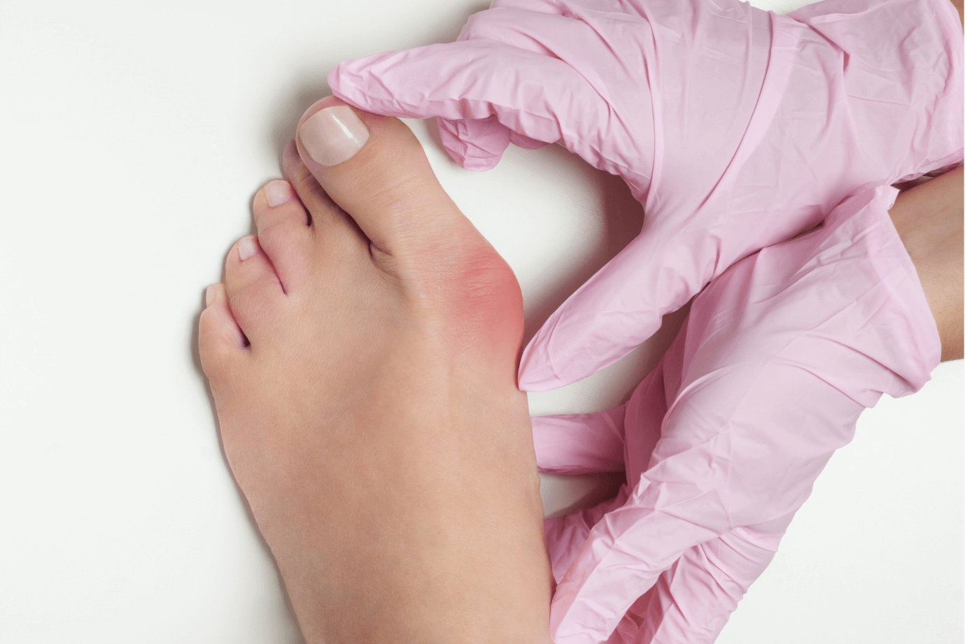 A person wearing pink medical gloves examining or providing care to a patient's foot, showing a red irritated area on the big toe.