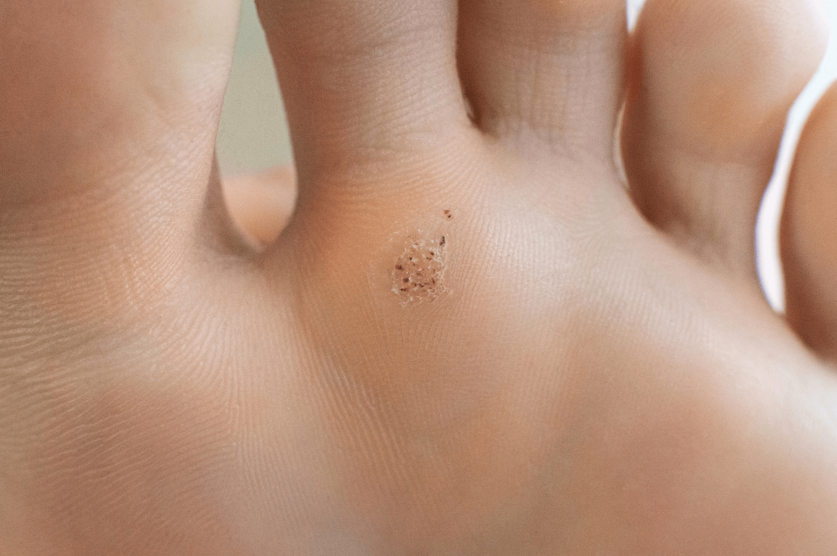flatirons foot & ankle clinic swift wart removal 