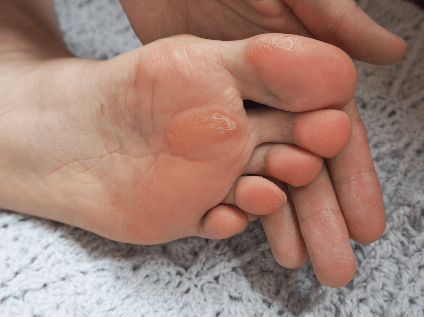 Close-up of a person's foot showing a blister on the heel, with skin peeling around it, resting on a textured gray surface.