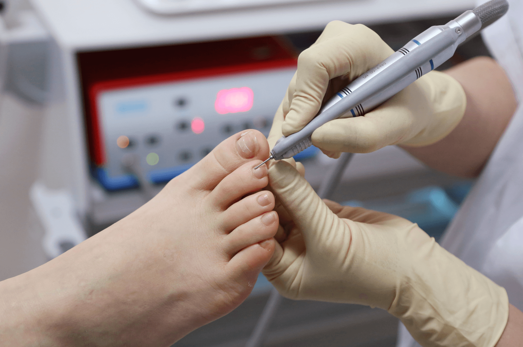 flatirons foot & ankle clinic toenail fungus 