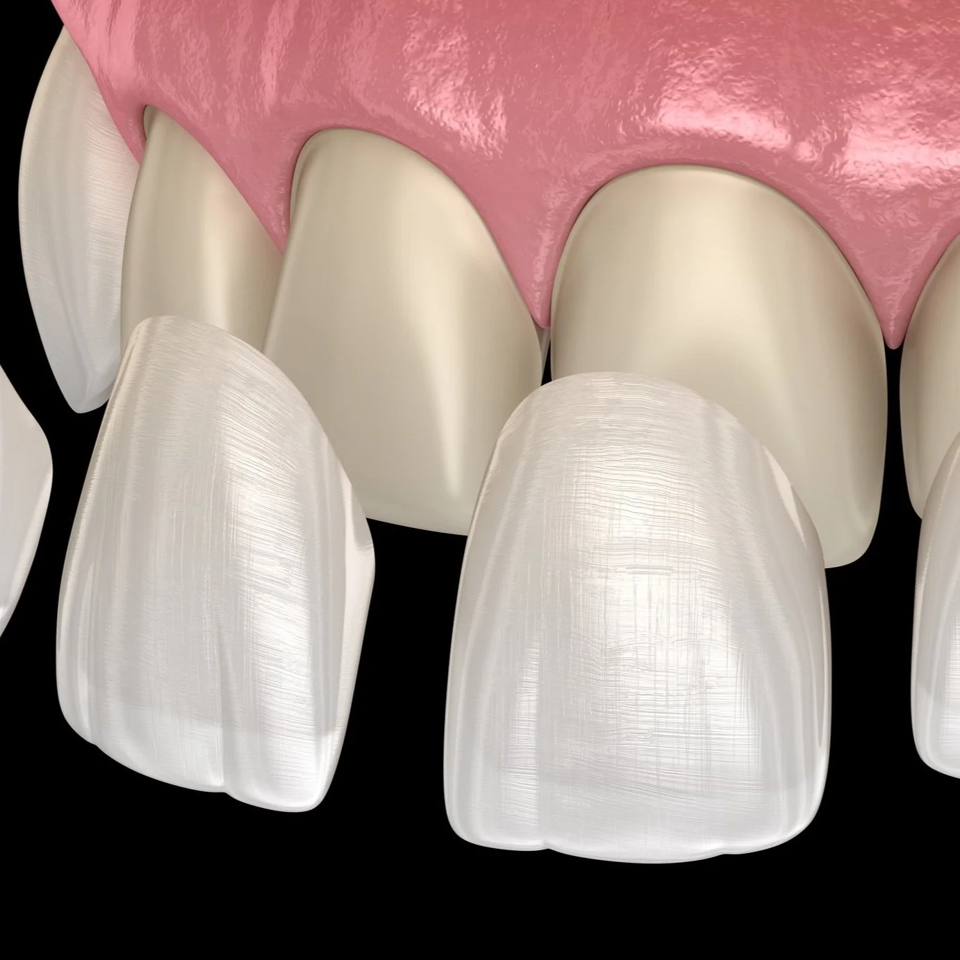 3D illustration of porcelain veneers being placed on upper front teeth to enhance smile aesthetics and correct imperfections.