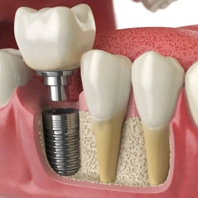 3D cross-sectional illustration of a dental implant with a titanium post anchored into the jawbone and a crown restoration placed above the gum line.