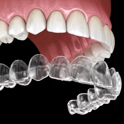 3D rendering of clear aligners being positioned over upper and lower teeth, demonstrating how Invisalign is used to straighten teeth discreetly.