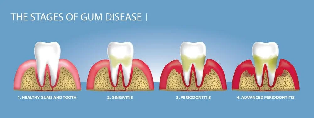 Illustration showing the four stages of gum disease: healthy gums and tooth, gingivitis, periodontitis, and advanced periodontitis, with progressive gum and bone deterioration.