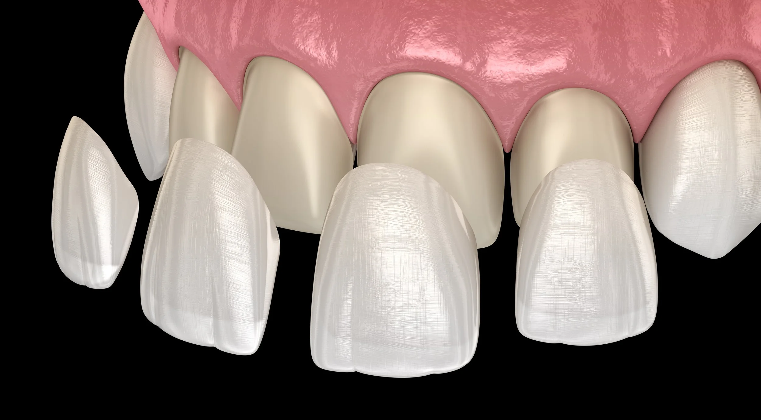 Cosmetic Veneers