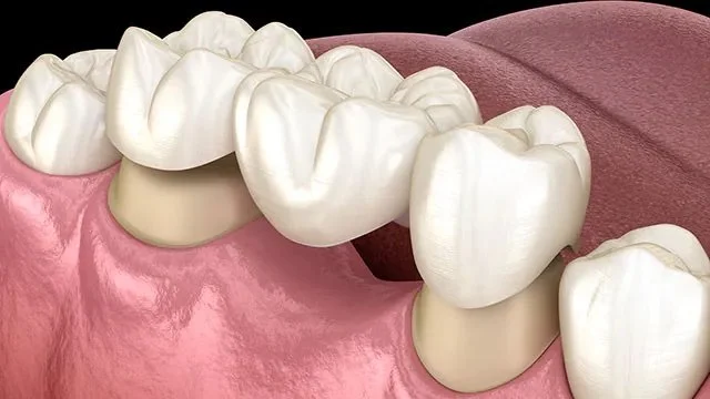 Dental Bridges