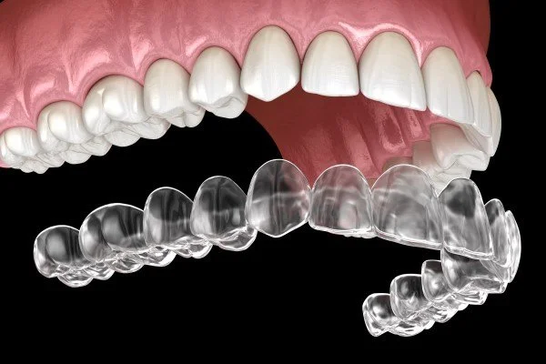 Invisalign