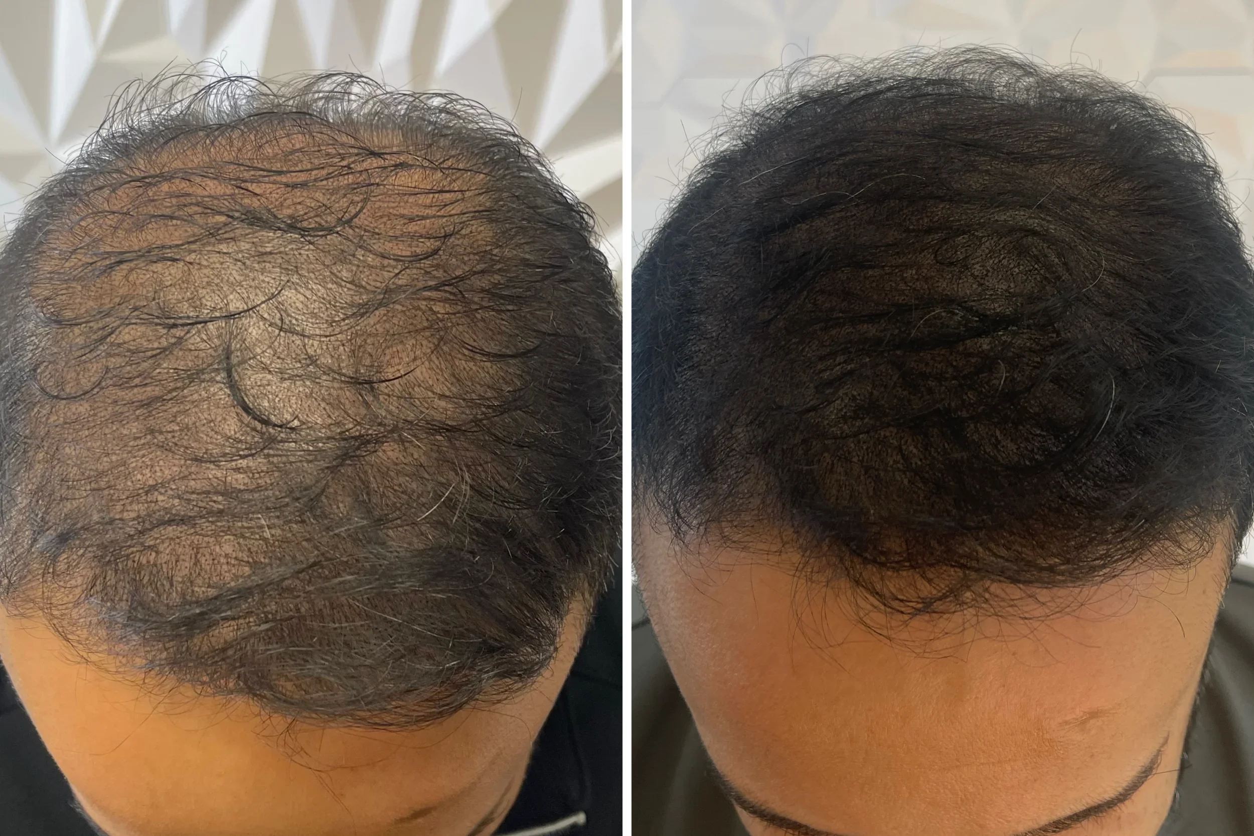 Hairline restoration on a thinning crown — 3 sessions, 1 year healed.