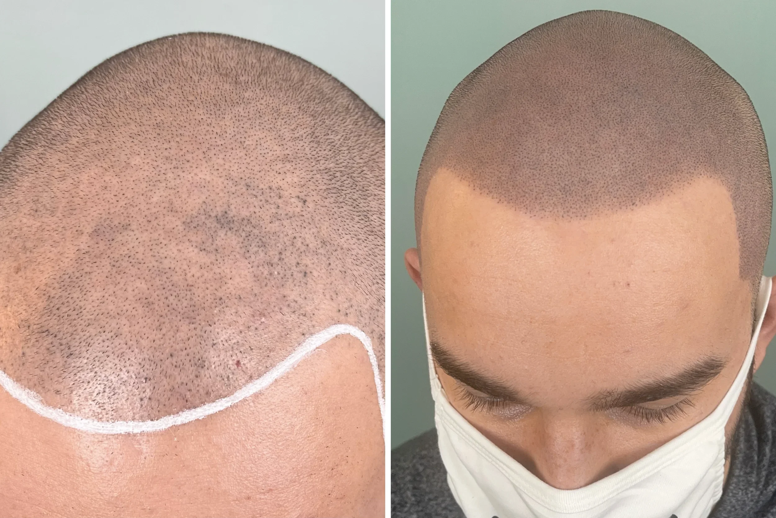 Correction of botched SMP from another clinic — 2 corrective sessions.