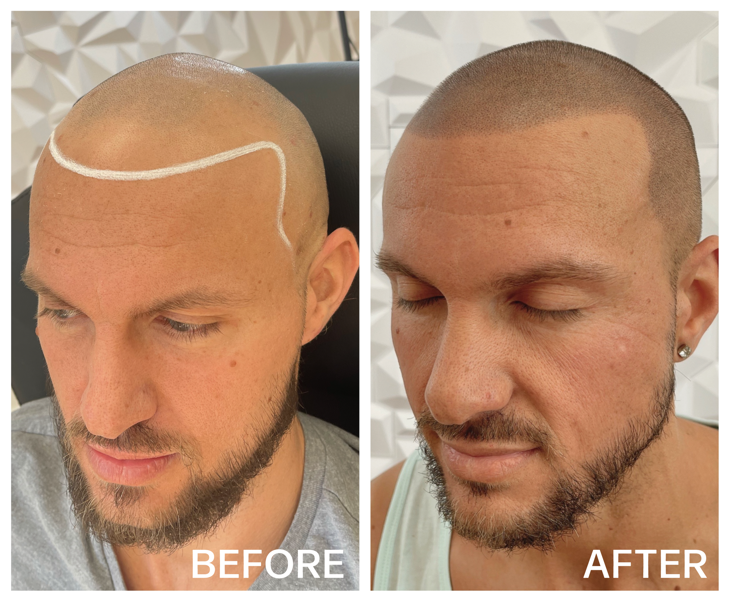 Before and after scalp micro pigmentation results performed by Scalpform by Crone Ink SMP in Indiana.