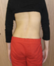 Front view of a person standing on the left leg with the left hip shifted forward, showing asymmetrical pelvic position.