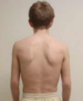 Rear view note of a Right Brachial Chain (R BC) pattern showing asymmetrical rib cage position, right posterior rib prominence, and altered upper trunk orientation commonly addressed in PRI-based physical therapy.