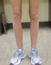 Close-up of a person standing with only the feet visible, showing asymmetrical wear patterns on the shoes.