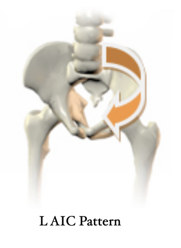A diagram of a pelvis demonstrating the Left AIC pattern. One side of the pelvis is twisted.