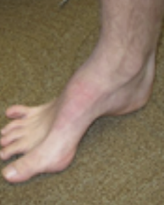 Feet demonstrating arch height differences, with the right foot showing a higher arch and the left foot a lower arch, often assessed in physical therapy or gait analysis.
