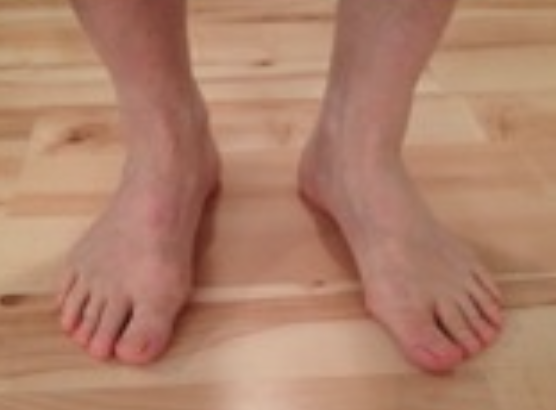 Image of feet used to assess posture, weight distribution, or foot alignment in physical therapy.